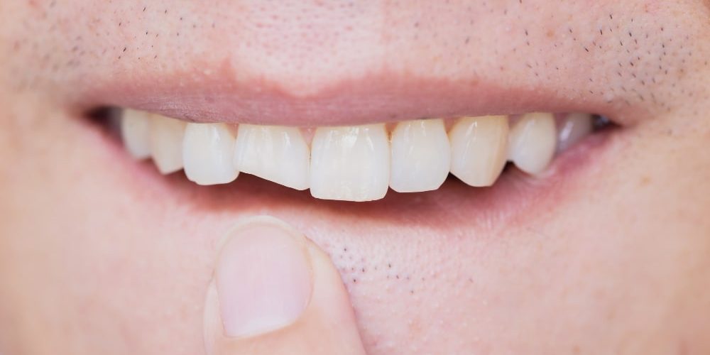 dientes rotos con grietas